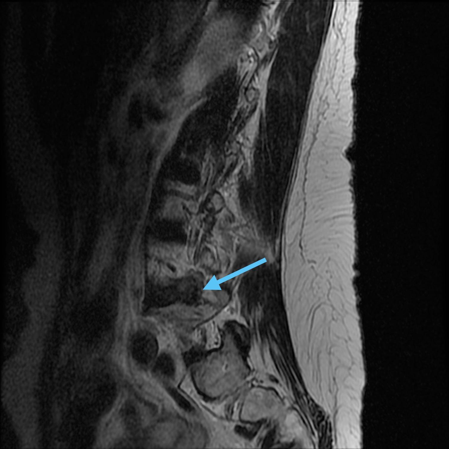 When Piriformis Was Actually Disc Herniation