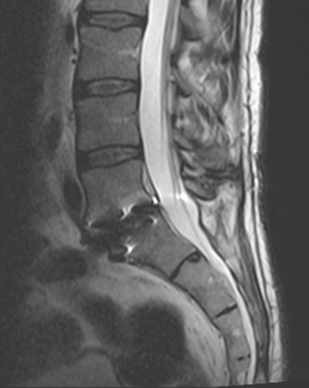 Adjacent Segment Disease After Fusion: Is It Inevitable?