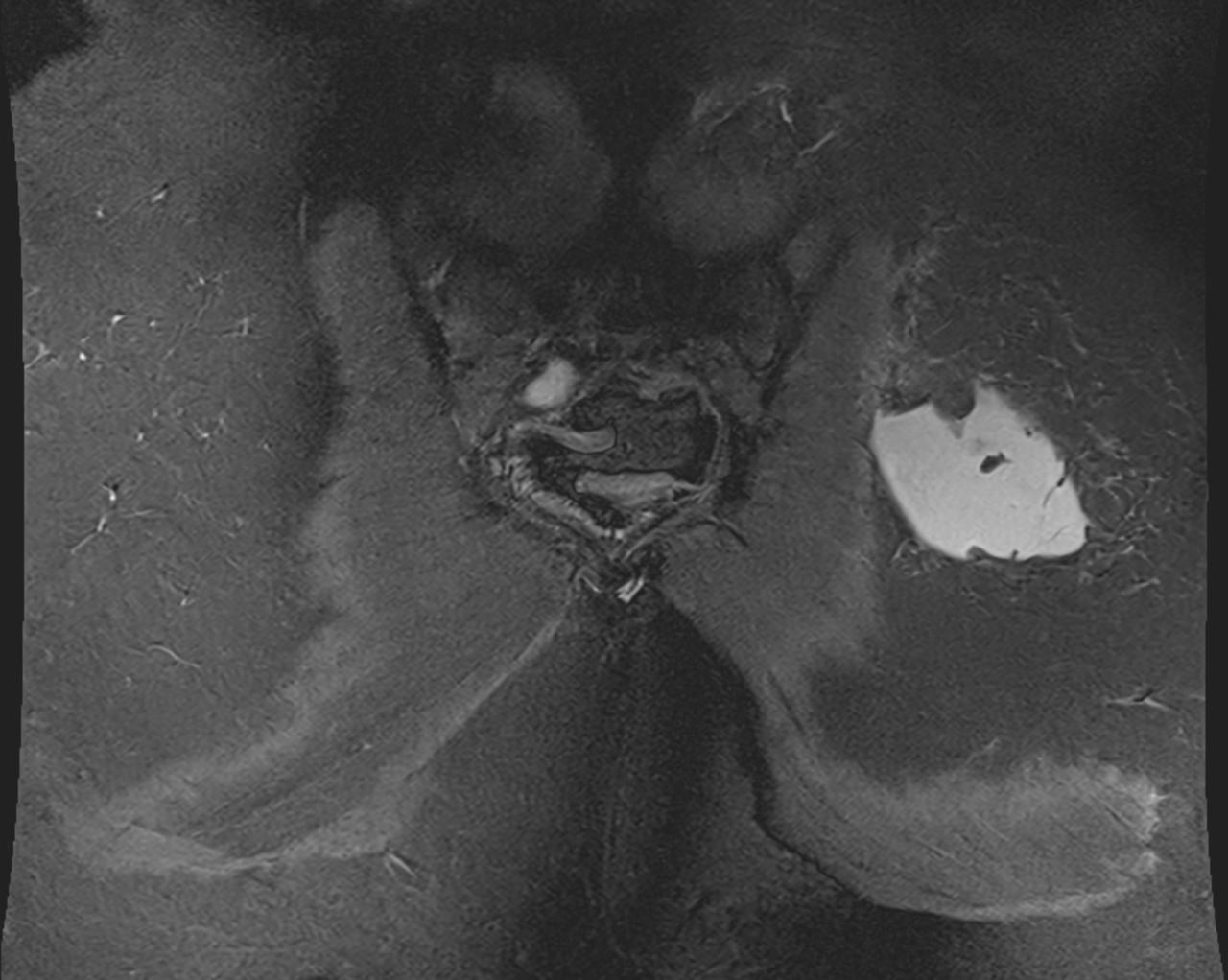 Deep Gluteal Syndrome: Trauma to Buttock Mimics Spine
